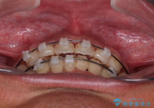 矯正治療途中で転院　遠方への転勤で通院困難な方の矯正治療の治療前