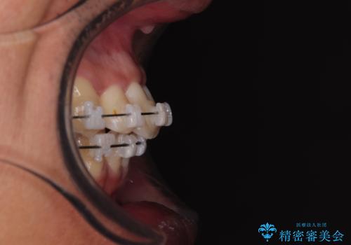 矯正治療途中で転院　遠方への転勤で通院困難な方の矯正治療の治療前