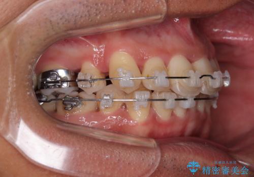 矯正治療途中で転院　遠方への転勤で通院困難な方の矯正治療の治療前