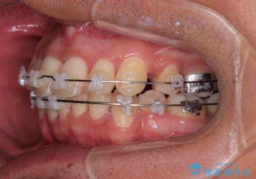矯正治療途中で転院　遠方への転勤で通院困難な方の矯正治療の治療前