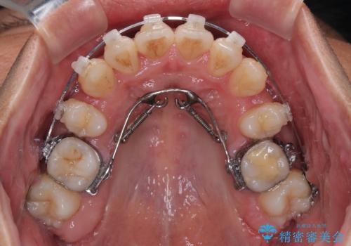 矯正治療途中で転院　遠方への転勤で通院困難な方の矯正治療の治療前