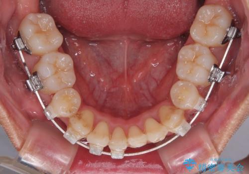 矯正治療途中で転院　遠方への転勤で通院困難な方の矯正治療の治療前