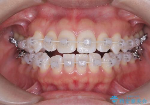 「歯を抜かずに、たった10ヵ月。」目立ちにくい大人の矯正の治療中