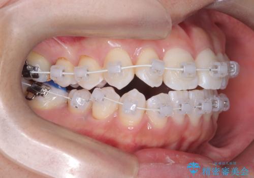 「歯を抜かずに、たった10ヵ月。」目立ちにくい大人の矯正の治療中