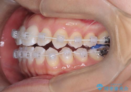 「歯を抜かずに、たった10ヵ月。」目立ちにくい大人の矯正の治療中