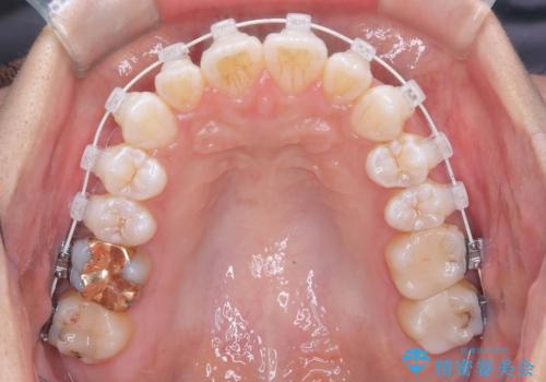 「歯を抜かずに、たった10ヵ月。」目立ちにくい大人の矯正の治療中