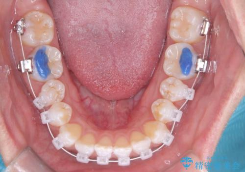 「歯を抜かずに、たった10ヵ月。」目立ちにくい大人の矯正