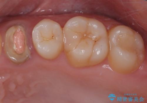 根元から折れてしまった歯をどうする?矯正かインプラントかを比較検討した症例の症例 治療前
