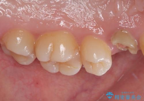 根元から折れてしまった歯をどうする?矯正かインプラントかを比較検討した症例の治療前