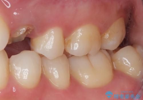 根元から折れてしまった歯をどうする?矯正かインプラントかを比較検討した症例の治療前