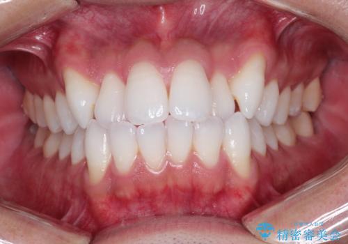 前歯の突出を防ぎながらガタつきを解消。上下左右4番抜歯による審美ワイヤー矯正の症例 治療前