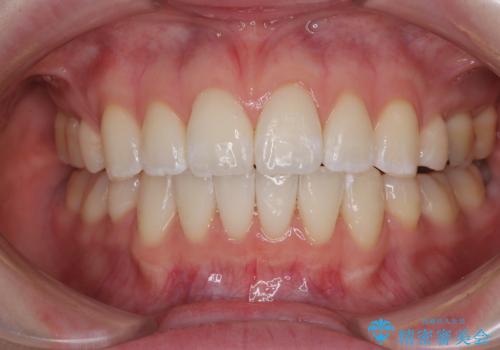 飛び出した前歯を引っ込める　ワイヤー装置での抜歯矯正治療の治療後