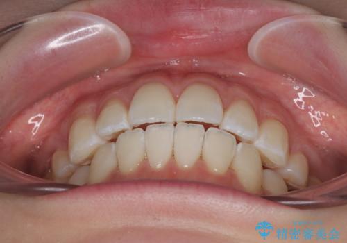 飛び出した前歯を引っ込める　ワイヤー装置での抜歯矯正治療の治療後