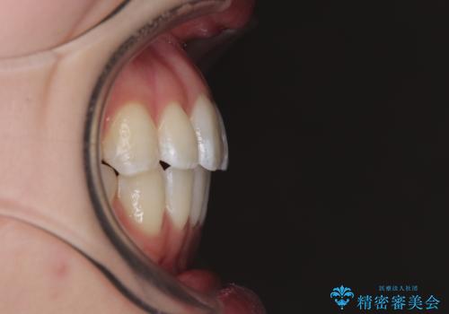 飛び出した前歯を引っ込める　ワイヤー装置での抜歯矯正治療の治療後