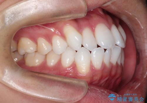 前歯の突出を防ぎながらガタつきを解消。上下左右4番抜歯による審美ワイヤー矯正の治療前