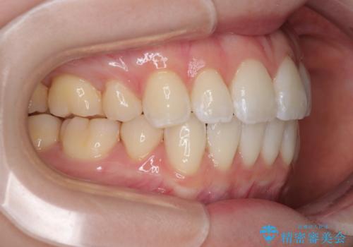 飛び出した前歯を引っ込める　ワイヤー装置での抜歯矯正治療の治療後