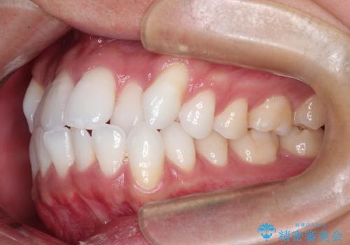 前歯の突出を防ぎながらガタつきを解消。上下左右4番抜歯による審美ワイヤー矯正の治療前