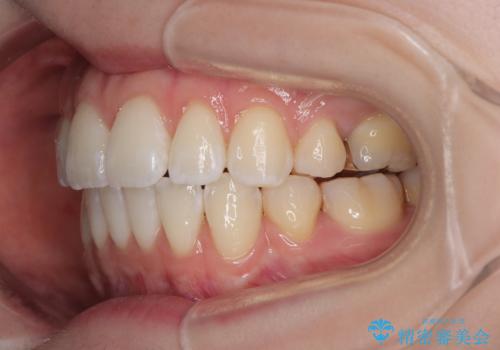 飛び出した前歯を引っ込める ワイヤー装置での抜歯矯正治療の治療後