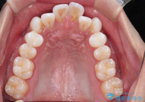 前歯の突出を防ぎながらガタつきを解消。上下左右4番抜歯による審美ワイヤー矯正の治療前