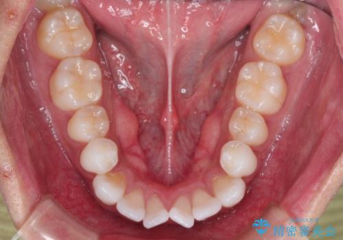 前歯の突出を防ぎながらガタつきを解消。上下左右4番抜歯による審美ワイヤー矯正の治療前