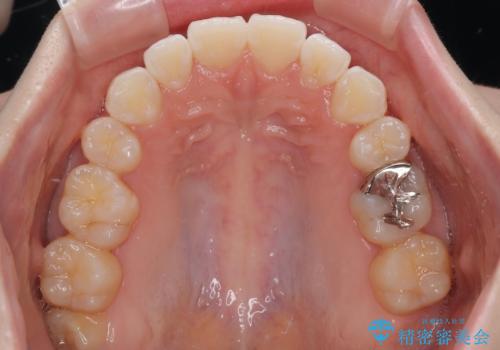 飛び出した前歯を引っ込める　ワイヤー装置での抜歯矯正治療の治療後