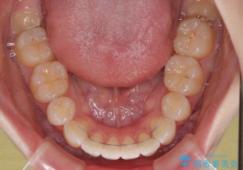 飛び出した前歯を引っ込める ワイヤー装置での抜歯矯正治療の治療後
