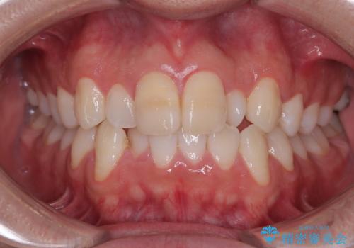 マウスピース矯正と迷った結果…管理のしやすさで選んだクリアブラケット矯正の症例の治療前