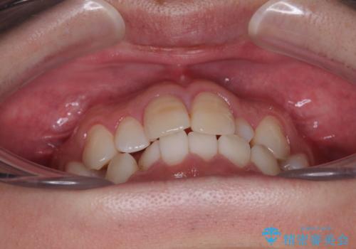 マウスピース矯正と迷った結果…管理のしやすさで選んだクリアブラケット矯正の症例の治療前