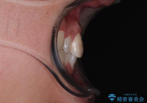 マウスピース矯正と迷った結果…管理のしやすさで選んだクリアブラケット矯正の症例の治療前