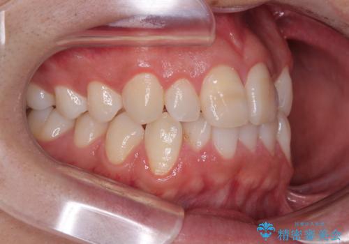 マウスピース矯正と迷った結果…管理のしやすさで選んだクリアブラケット矯正の症例の治療前