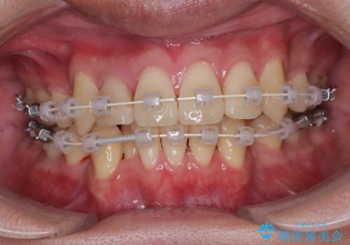 八重歯と重なった前歯　目立たない装置での抜歯矯正の治療中