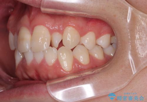 マウスピース矯正と迷った結果…管理のしやすさで選んだクリアブラケット矯正の症例の治療前