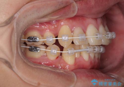 八重歯と重なった前歯　目立たない装置での抜歯矯正の治療中