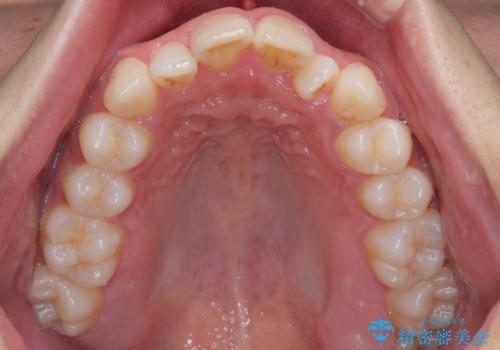 マウスピース矯正と迷った結果…管理のしやすさで選んだクリアブラケット矯正の症例の治療前