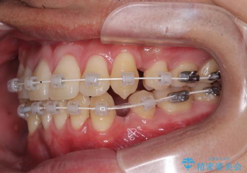 八重歯と重なった前歯　目立たない装置での抜歯矯正の治療中