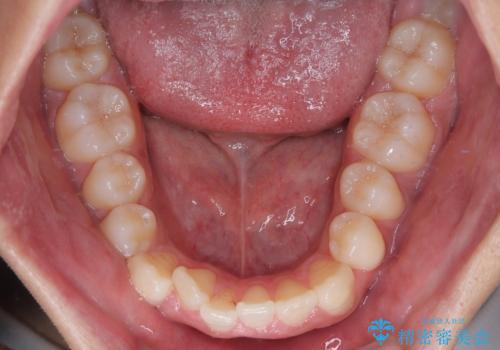 マウスピース矯正と迷った結果…管理のしやすさで選んだクリアブラケット矯正の症例の治療前