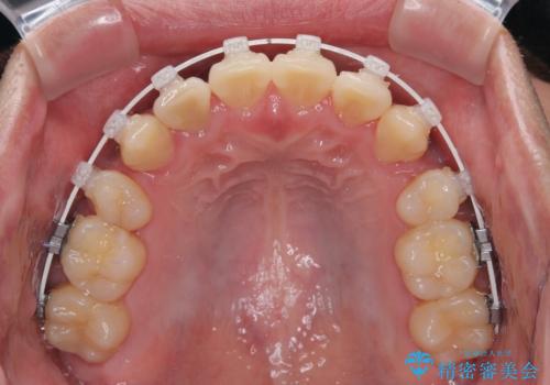 八重歯と重なった前歯　目立たない装置での抜歯矯正の治療中