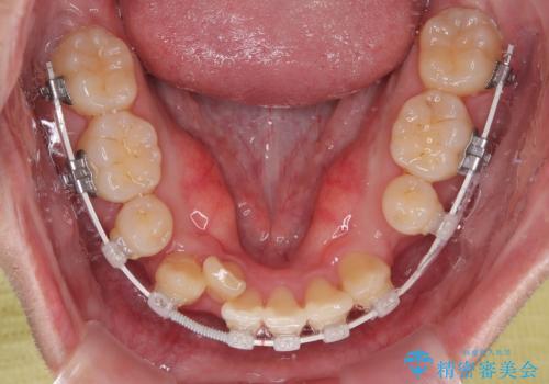 八重歯と重なった前歯　目立たない装置での抜歯矯正の治療中