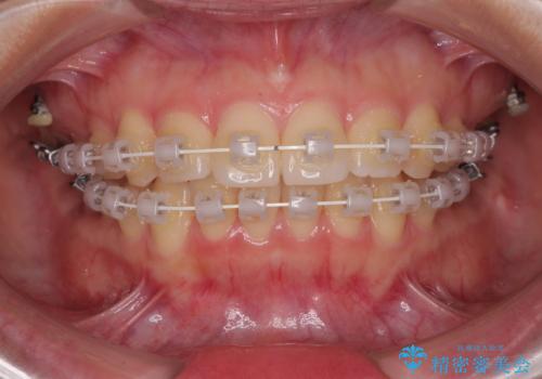 インビザラインの自己管理は煩わしい ワイヤー矯正で短期間矯正治療の治療中