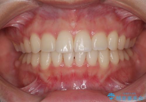 インビザラインの自己管理は煩わしい ワイヤー矯正で短期間矯正治療の治療後