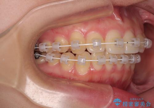 インビザラインの自己管理は煩わしい ワイヤー矯正で短期間矯正治療の治療中