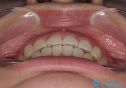 インビザラインの自己管理は煩わしい　ワイヤー矯正で短期間矯正治療の治療後