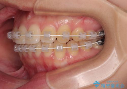インビザラインの自己管理は煩わしい　ワイヤー矯正で短期間矯正治療の治療中