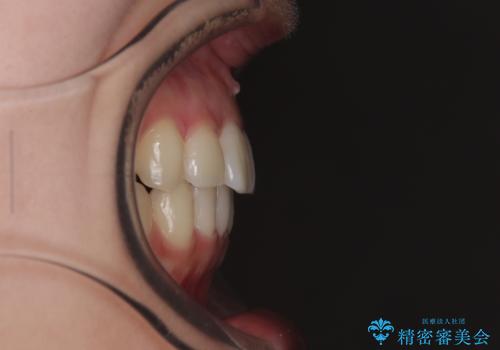 インビザラインの自己管理は煩わしい ワイヤー矯正で短期間矯正治療の治療後