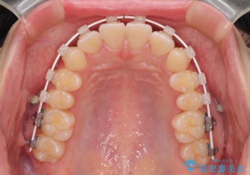 インビザラインの自己管理は煩わしい　ワイヤー矯正で短期間矯正治療の治療中