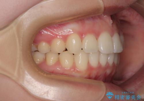 インビザラインの自己管理は煩わしい ワイヤー矯正で短期間矯正治療の治療後