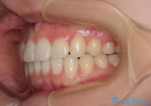 インビザラインの自己管理は煩わしい　ワイヤー矯正で短期間矯正治療の治療後