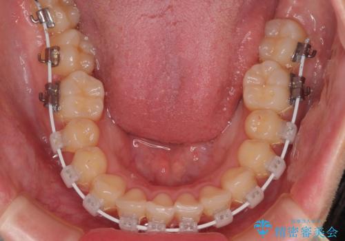 インビザラインの自己管理は煩わしい ワイヤー矯正で短期間矯正治療の治療中