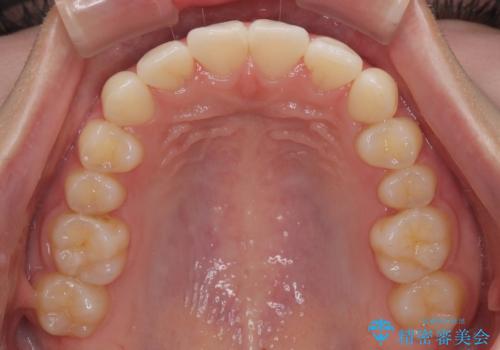 インビザラインの自己管理は煩わしい　ワイヤー矯正で短期間矯正治療の治療後