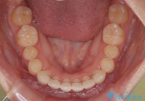 インビザラインの自己管理は煩わしい ワイヤー矯正で短期間矯正治療の治療後